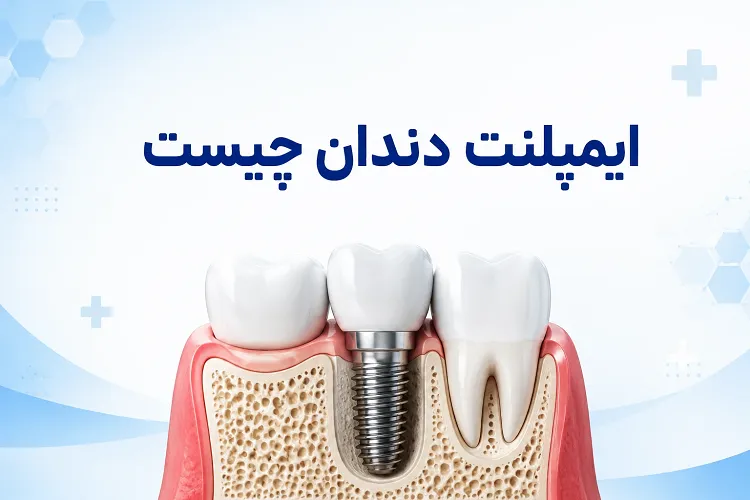 ایمپلنت دندان چیست؟ راهنمای کامل مزایا، مراحل