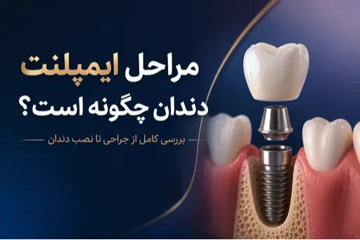 مراحل ایمپلنت دندان؛ از جراحی تا نصب دندان