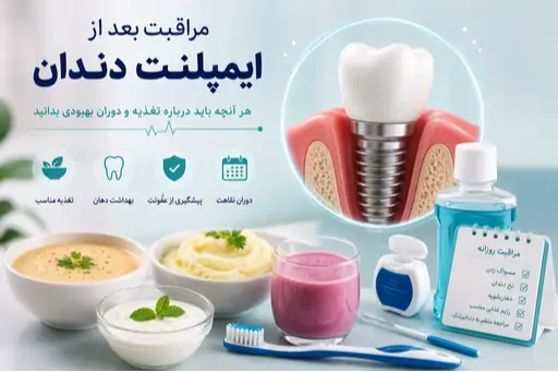 بعد از کاشت ایمپلنت این اشتباهات را تکرار نکنید!
