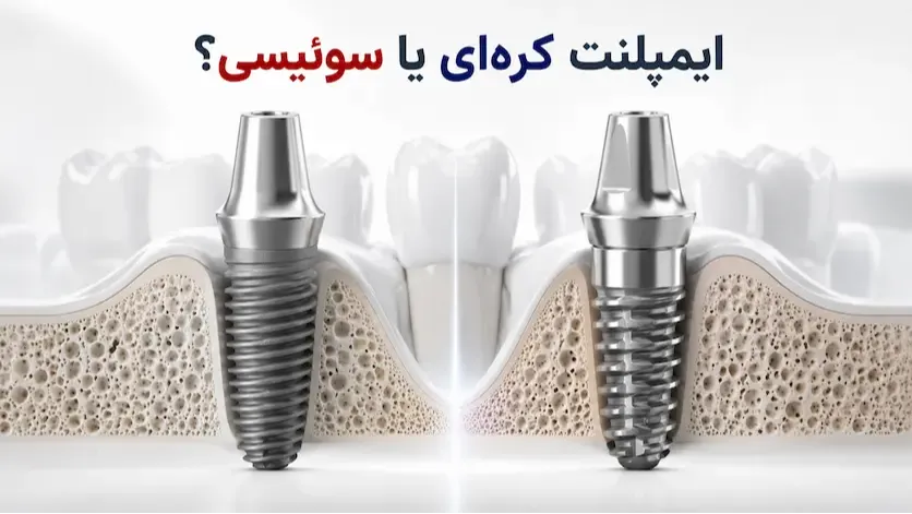 ایمپلنت کره‌ای یا سوئیسی؛ کدام انتخاب بهتری است؟