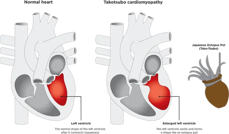 💔 دل شکسته و سنگی که قلب را می‌فشارد