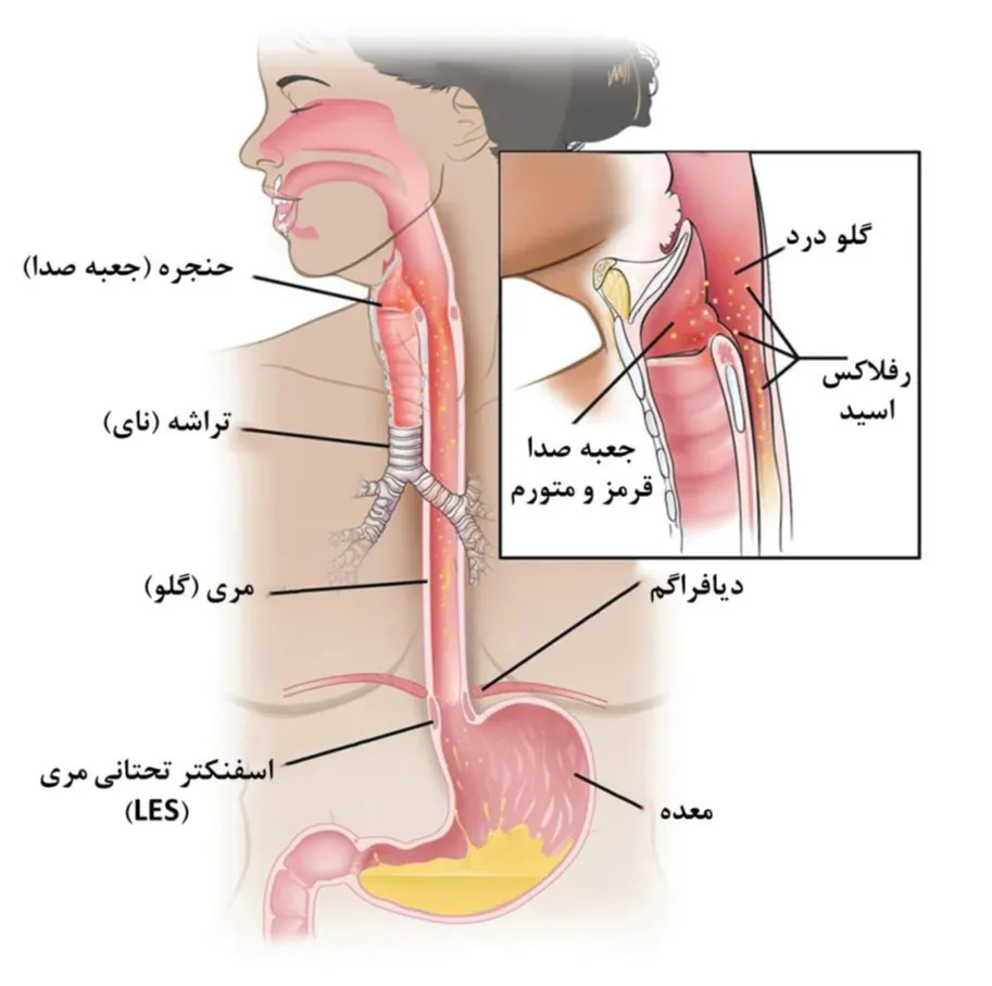 بازخوانی «بخارات معده» و تبیین اثرات آن بر حلق و بینی