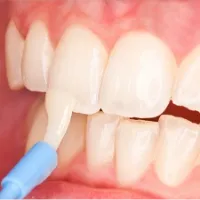 اشنایی با فلوراید تراپی